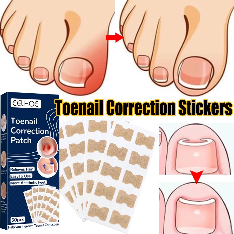 50Pcs Nail Correction Stickers Ingrown Toenail Corrector Patches For