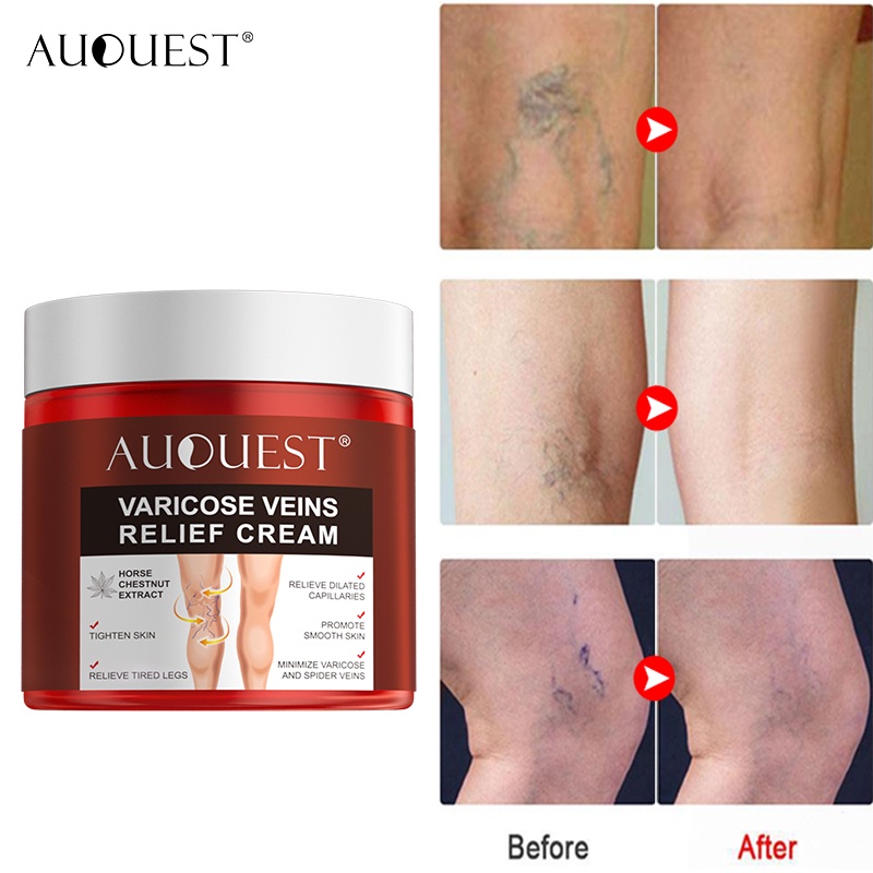 AUQUEST Varicose Veins Treatment Cream Relieve Tired Legs Dilated