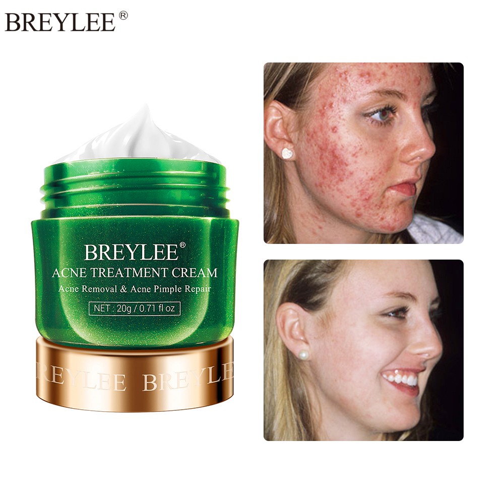 Breylee Acne Treatment Cream Anti Acne Face Cream Shopee Singapore