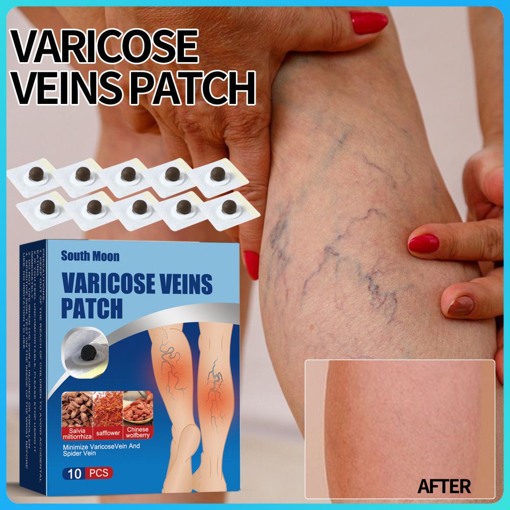 South Moon Varicose Veins Relief Cream Leg Vasculitis Phlebitis Spider