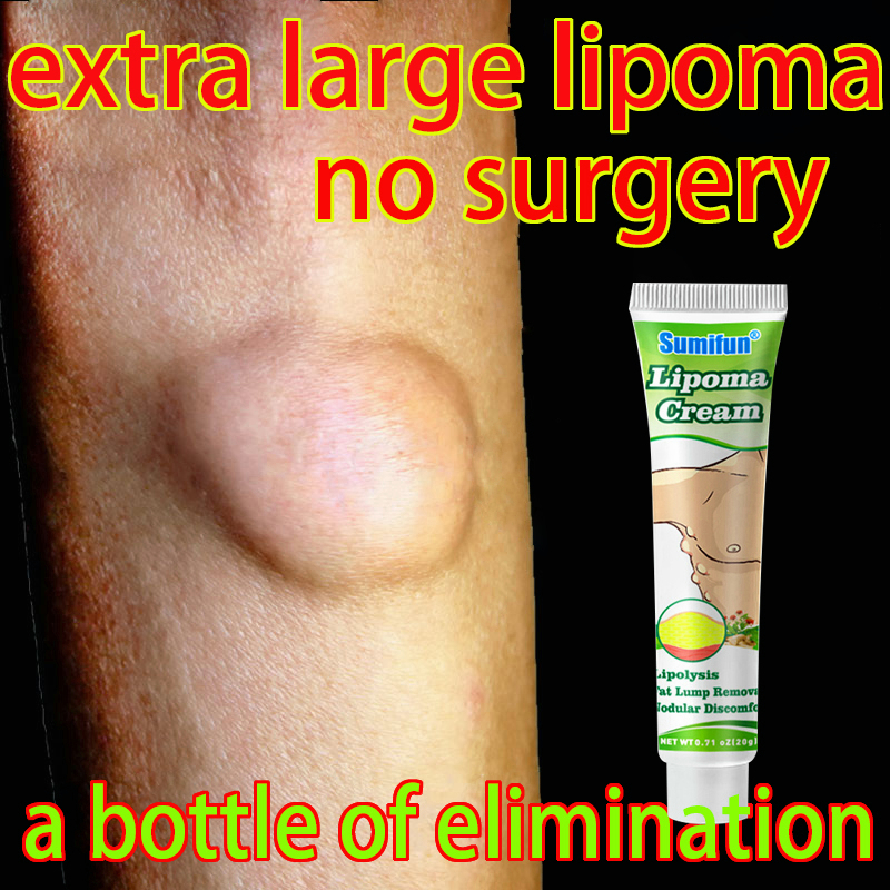 Lipoma Cream Lipoma Removal Cream 30g Lipoma Lump Bulge External