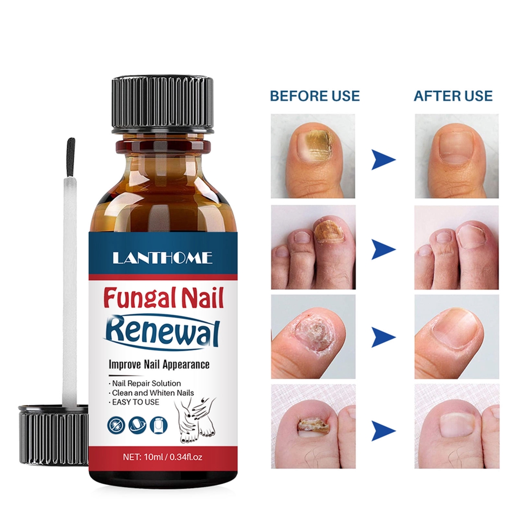Lanthome Herbal Fungal Nail Renewal Anti Fungal for nail repair and
