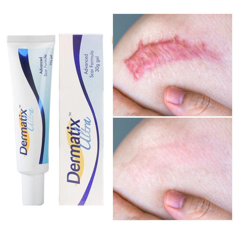 Dermatix Effective Scar Removal Cream Scar Gel Old Scars Acne Scars ...