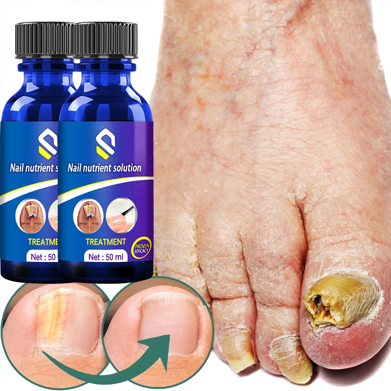 Nail Fungus Treatment Essence Nails Foot Repair Toe Nail Fungal Removal