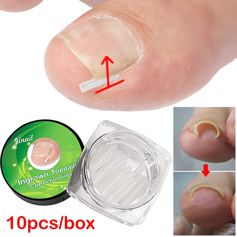 1 box (10 pieces) Ingrown Toenail Correction Straightening Clips ...