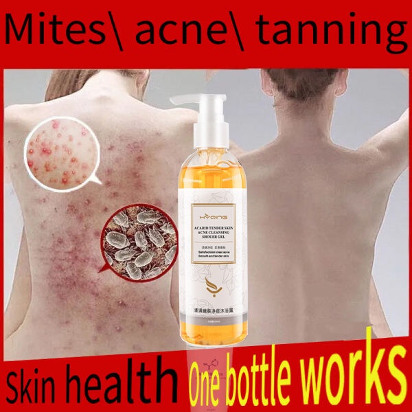 Acne Body Wash Acne Removal Mites Removal Melanin Removal Exfoliation