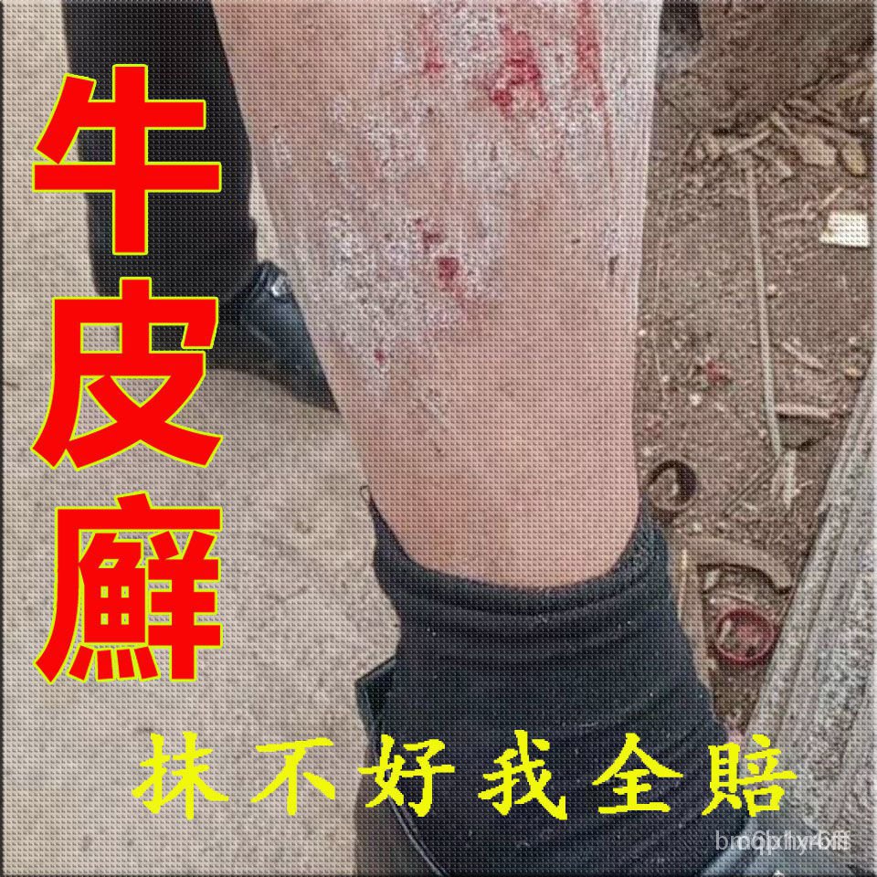 Imported Psoriasis Cream Anti-itching Special Effect For Psoriasis 