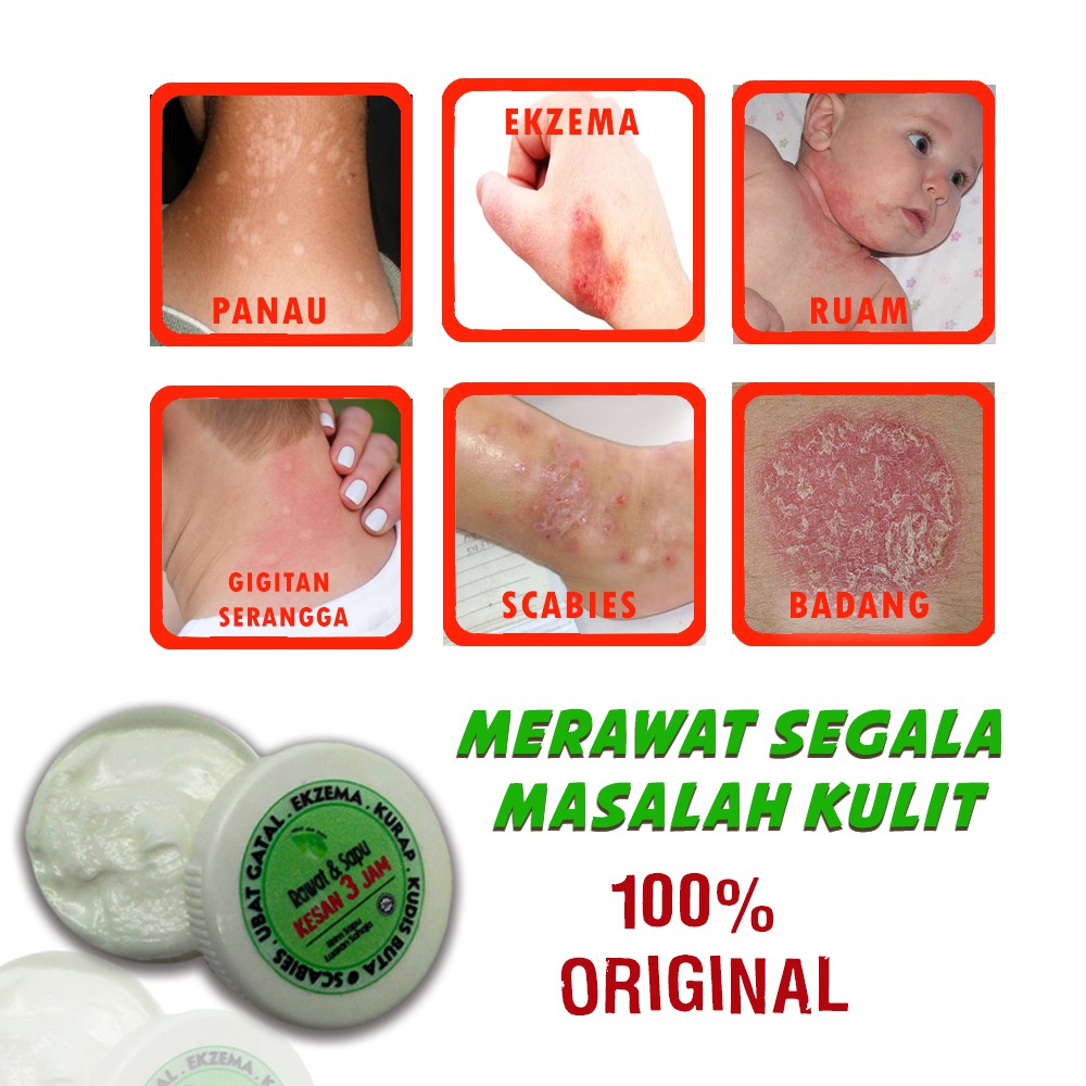 Medicine for itching, scabies, rashes, allergies, athlete's foot ...