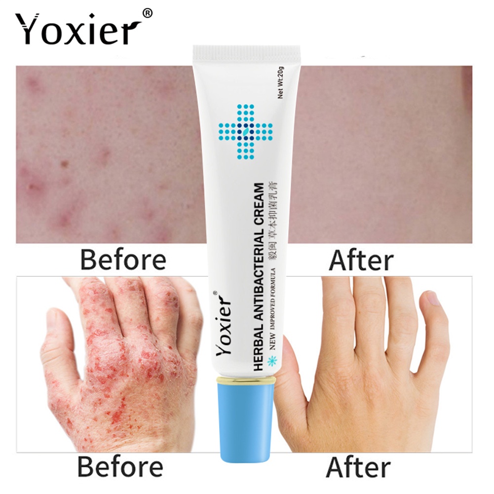 20g Yoxier Eczema Cream Antibacterial Psoriasis Cream Antipruritic