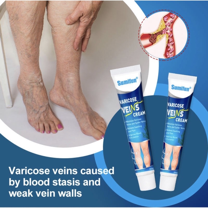 Herbal Medical Ointment for Varicose Veins and Vasculitis Treatment ...