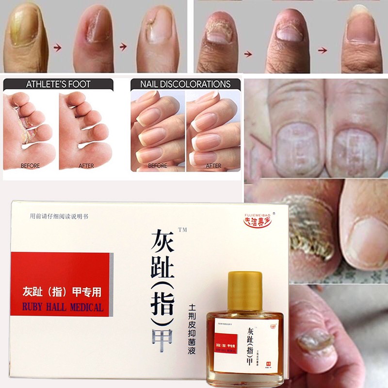 Nail repair onychomycosis antibacterial liquid set Treatment of fungal