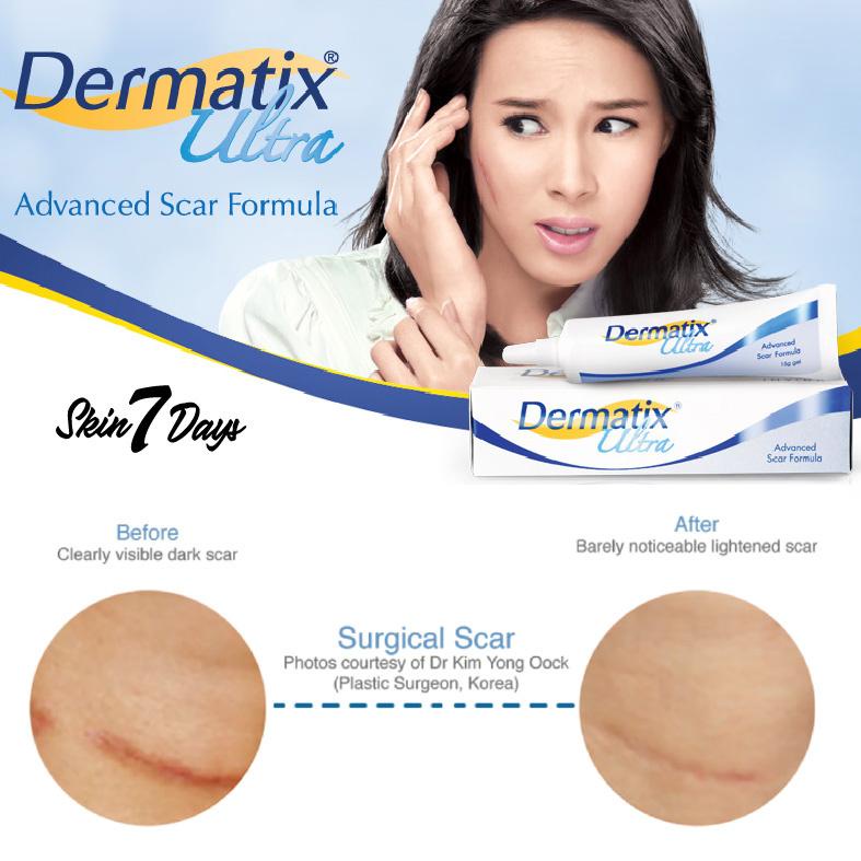 Ultra Dermatic Dermatix Ultra Advanced Scar Formula Gel Cream Code J Shopee Singapore