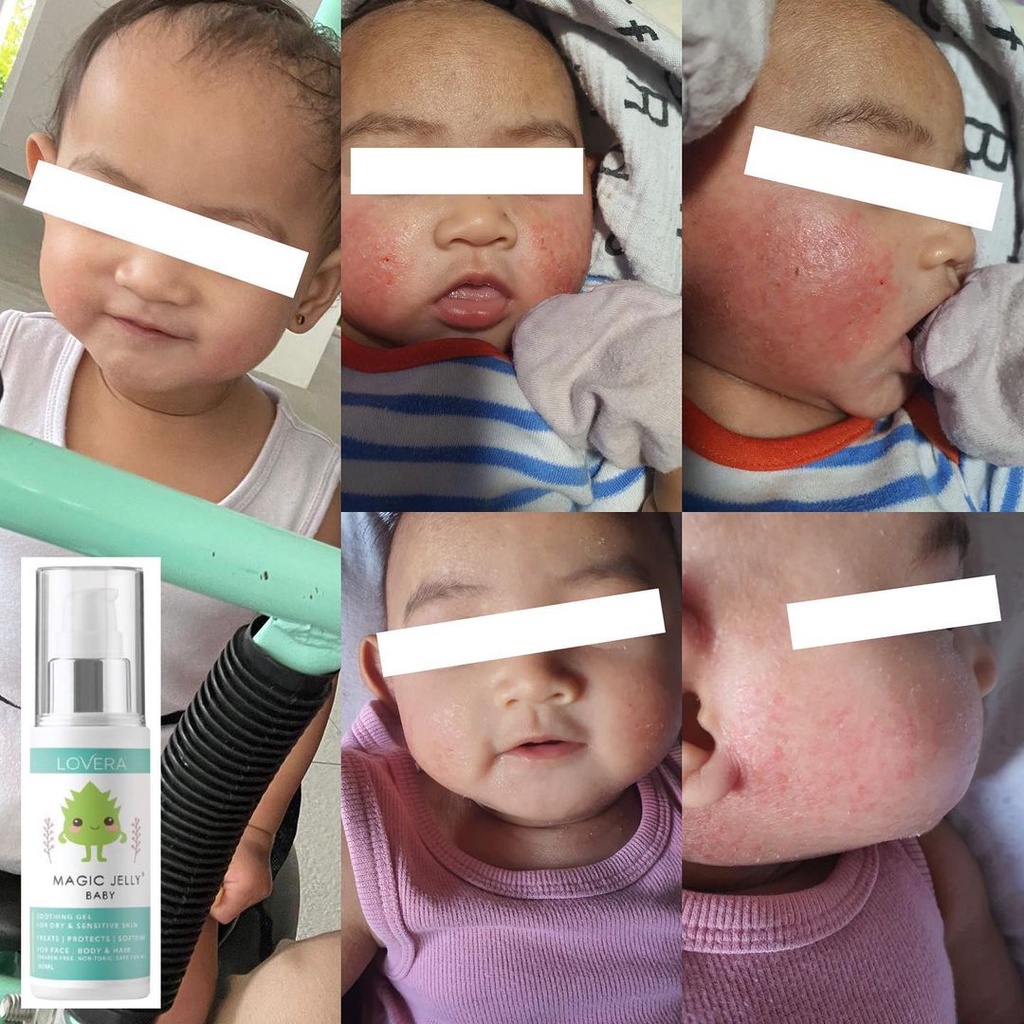 Magic Jelly baby (baby Eczema, Itchy Skin, Dry Skin, Diaper Rash, Milk Rash, sensitive Skin