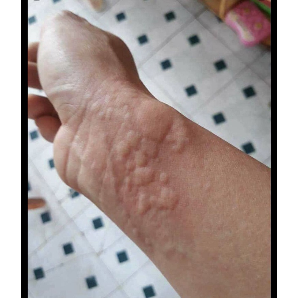 Herbal Blows Away Skin Rashes, Eliminates Itching, Rashes, Hives, and ...
