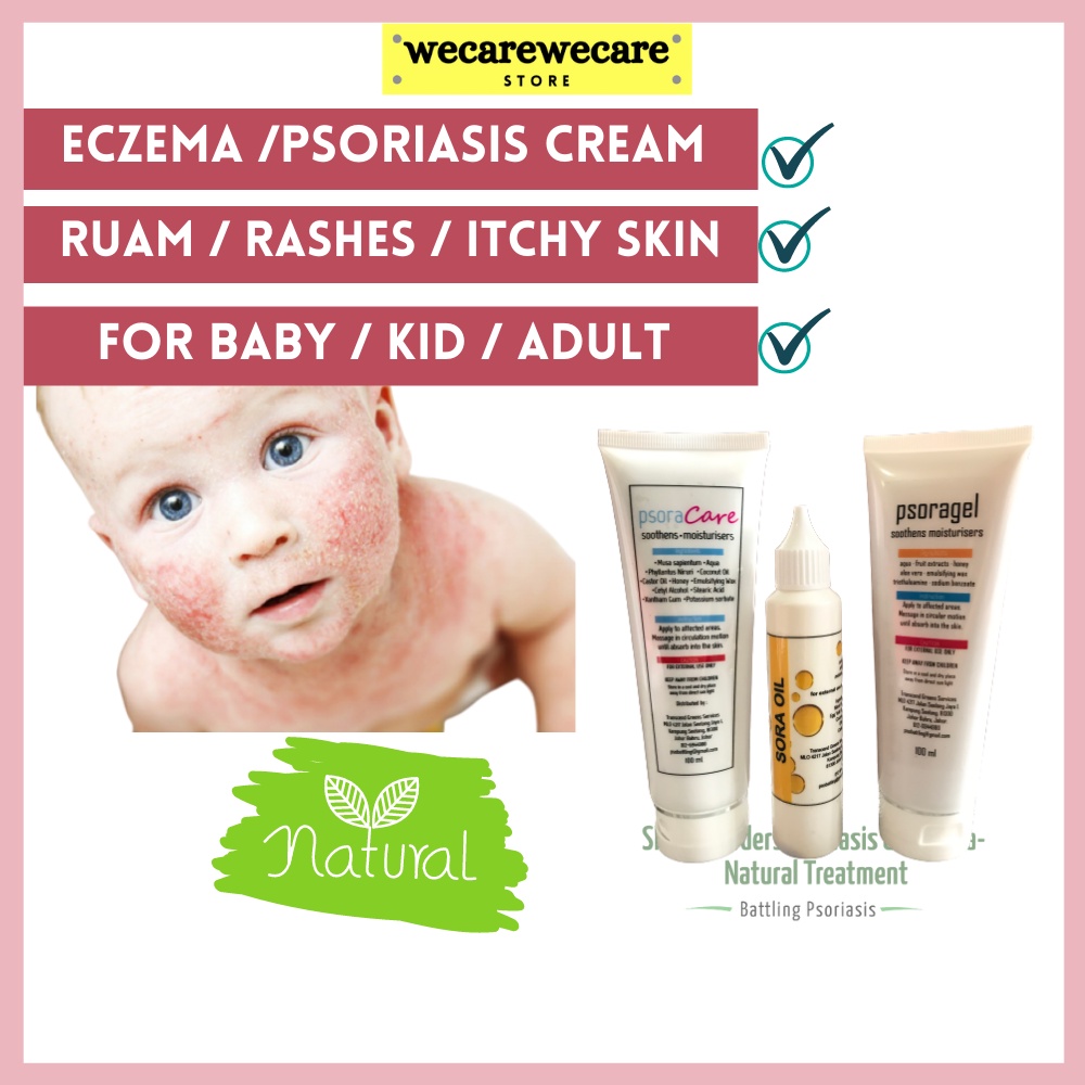 Eczema cream baby eczema psoriasis rashes rashes itchy skin Reddish
