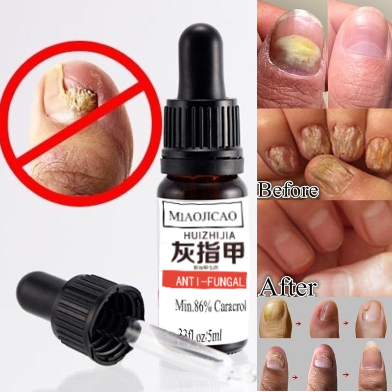 10ml antifungal maximum strength TOENAIL FUNGUS athlete foot fungus