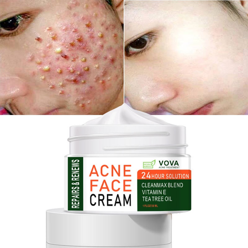 VOVA ACNE FACE CREAM 30ml Shopee Singapore
