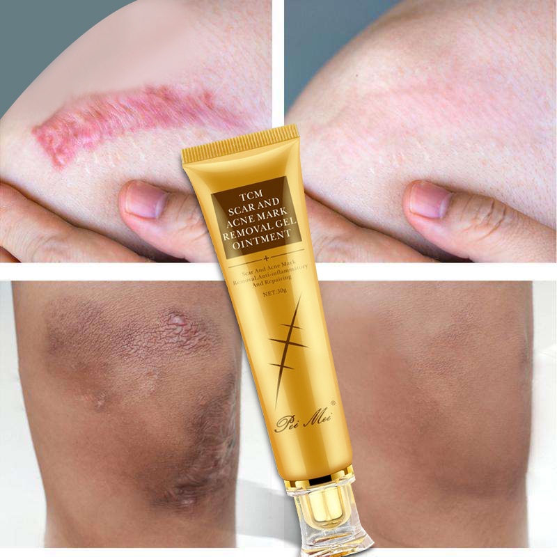 scar-removal-cream-peklat-remover-acne-scar-remover-stretch-mark