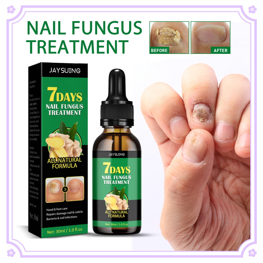 Jaysuing/ouhoe 7days Ginger Nail Foot Antifungal Remove Onychomycosis