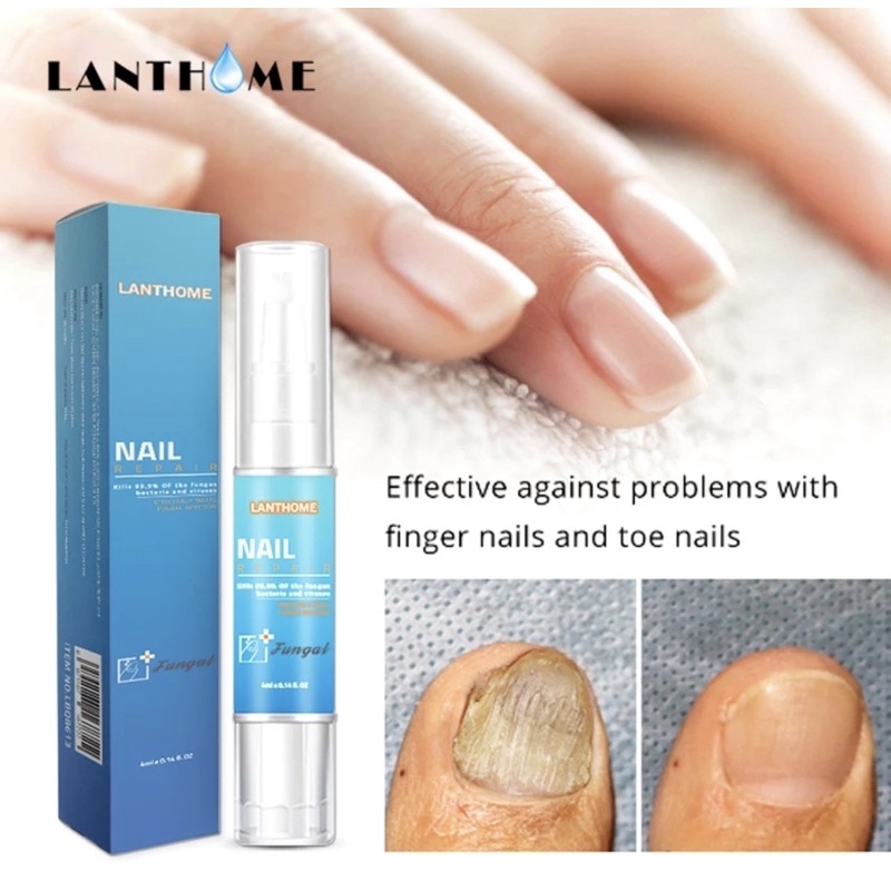 LANTHOME Fungal Nail Treatment Effective Repair Pen for Onychomycosis and Paronychia Ideal