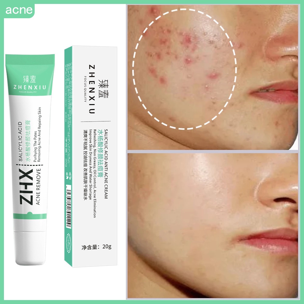 Salicylic Acid Acne Cream Remove Blackhead Oil Control AntiAcne Treatment Repair Pimple Acne