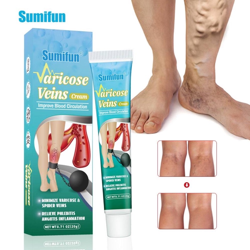 HIJAU Sumifun varicose Veins CREAM Veins CREAM varicose Veins varicose ...