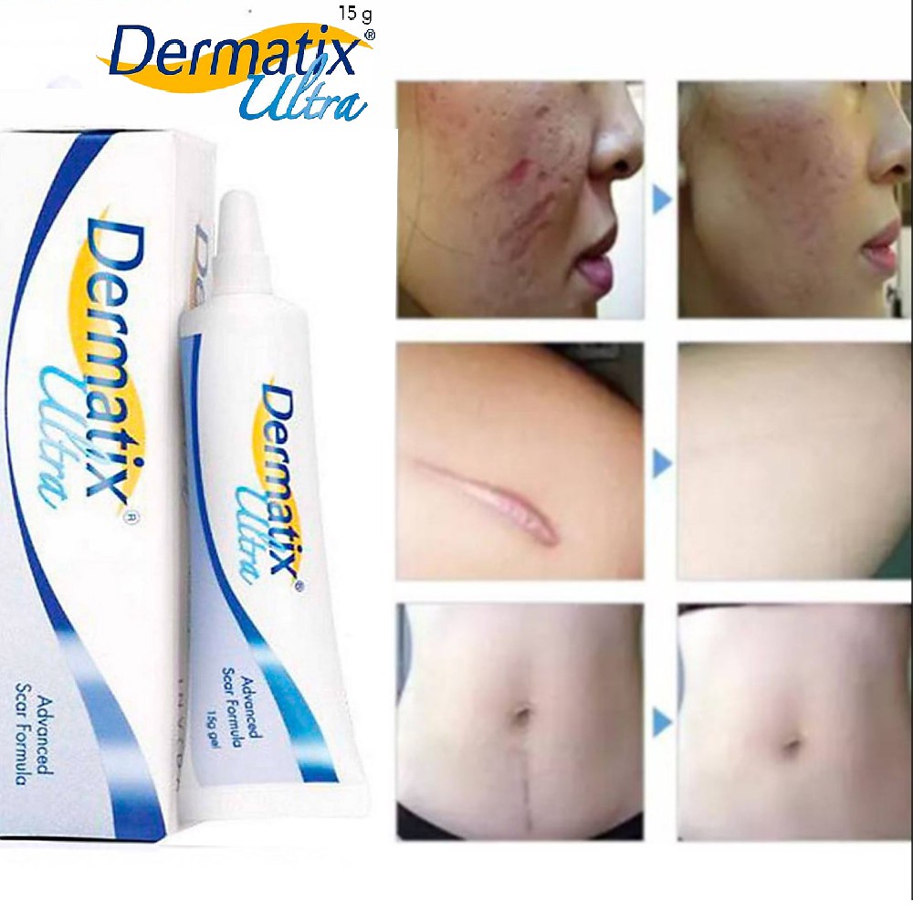 Australia dermatix scar silicone gel ointment scars caesarean section