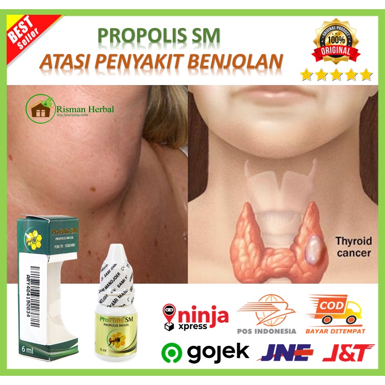 Herbal Medicine For Lumps Lipoma Lumps In The Neck Walatra Gland ...