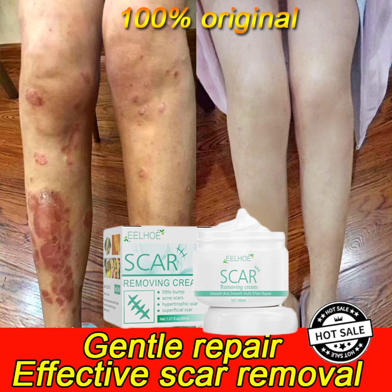 Eelhoe Scar Remover Cream Peklat 30ml Repair Skin Care Stretch Marks Burn Scar Remover For Body 6984