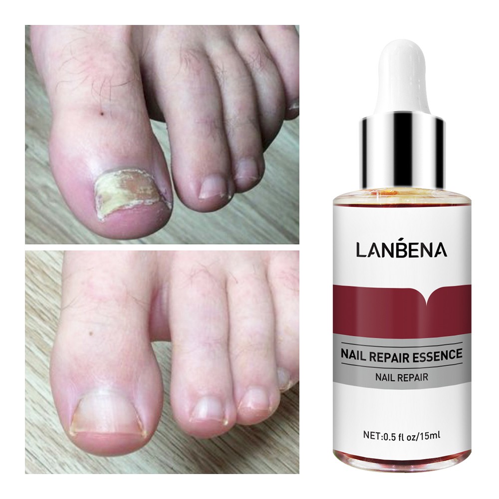 LANBENA Nail Repair Essence Serum Fungal Nail Treatment Remove  Onychomycosis Toe 15ml | Shopee Singapore