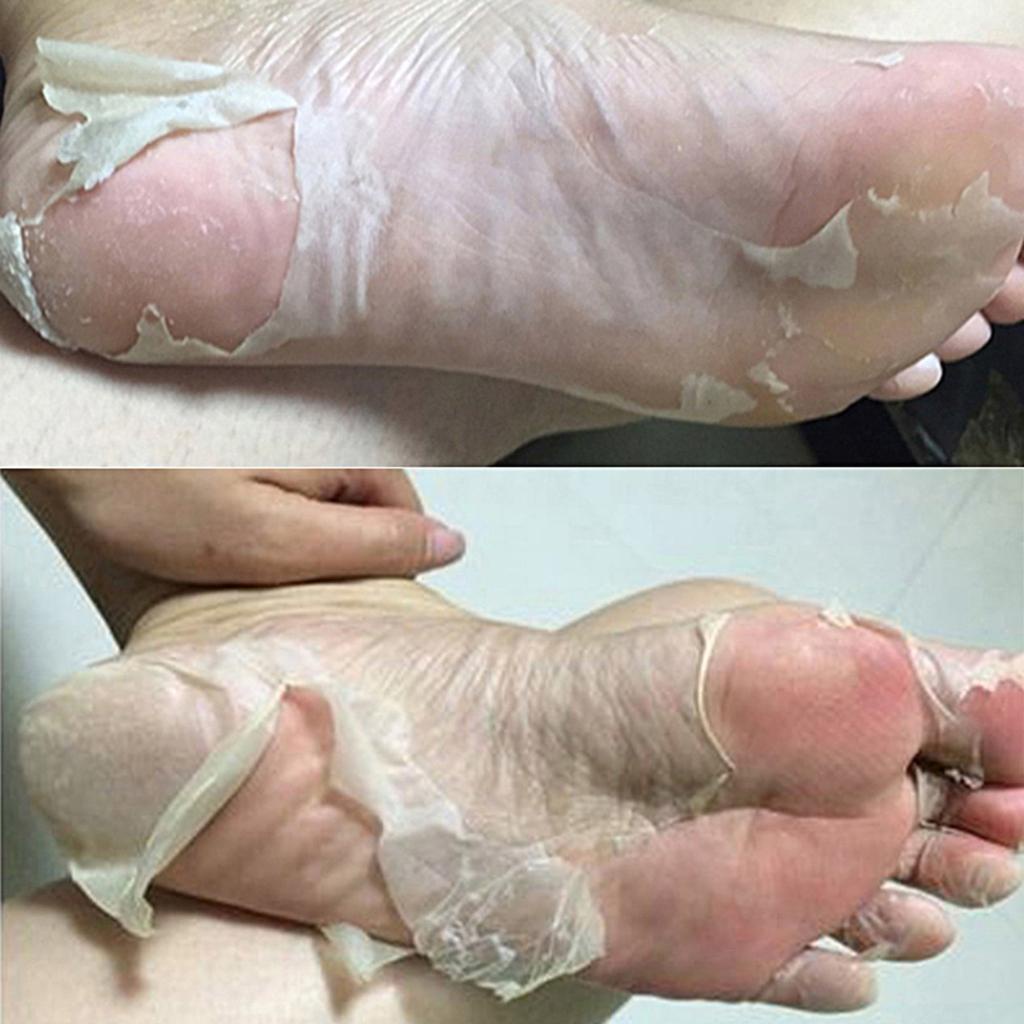 Remove peeling skin 2025 from feet