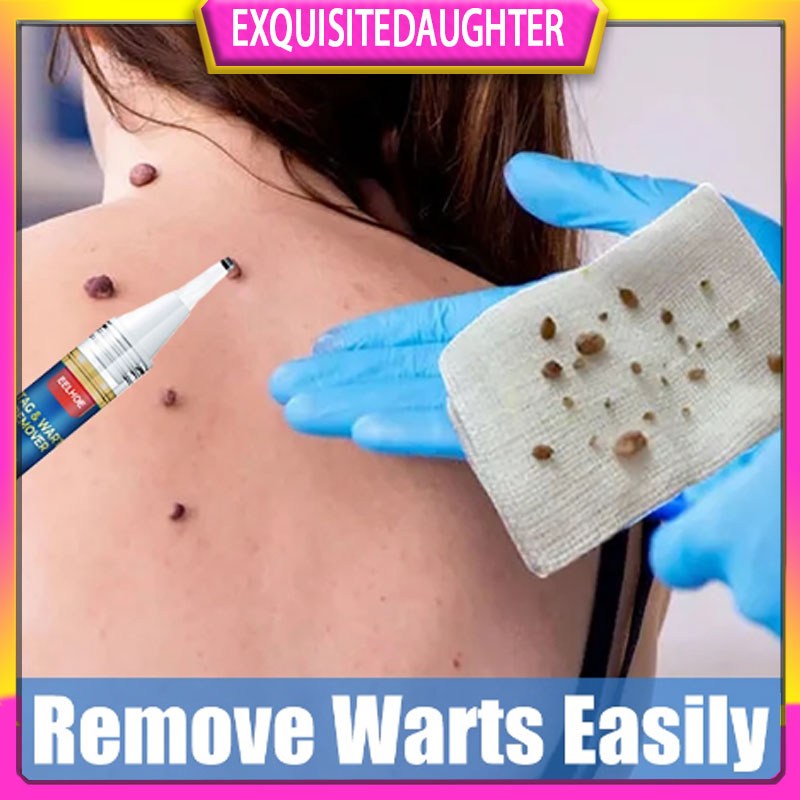 Warts Remover Pen For Body Warts Corn Moles Genital Warts Treatment Cream Shopee Singapore 2711