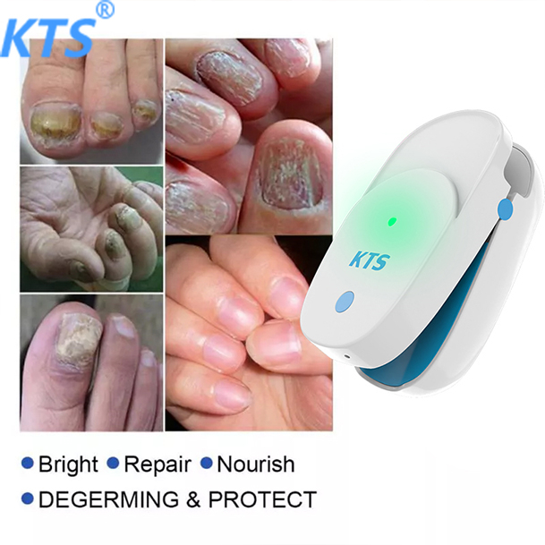 KTS 905NM Painless Nail Fungus Treatment Instrument Laser Feet Infrared