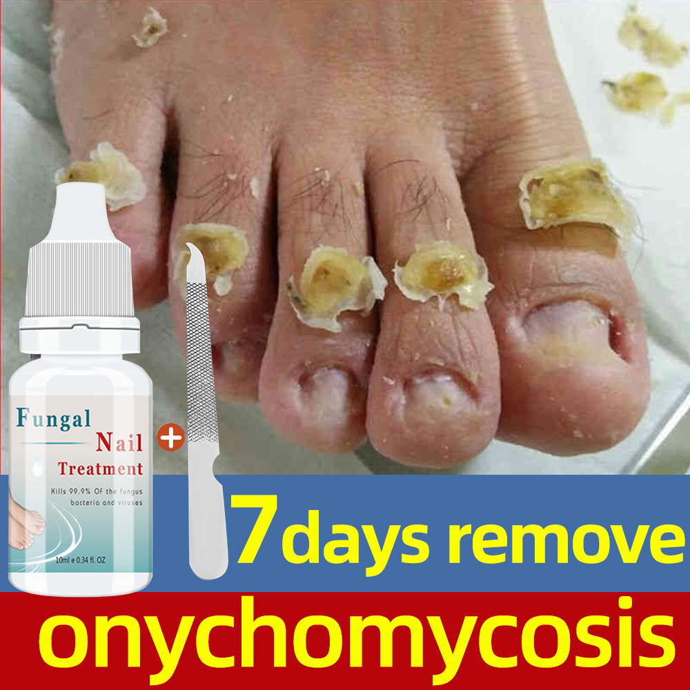 Lanthome Nail Repair Serum Essence Fungal Nail Care Removal of Onychomycosis Toe Hand Foot Skin