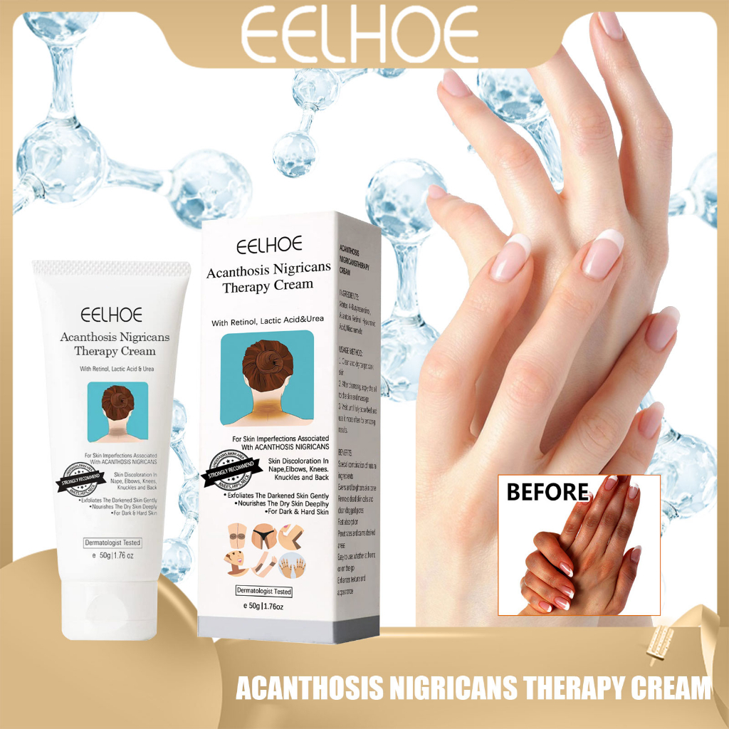 EELHOE Acanthosis nigricans Therapy Cream Nigrifix Cream Whitening