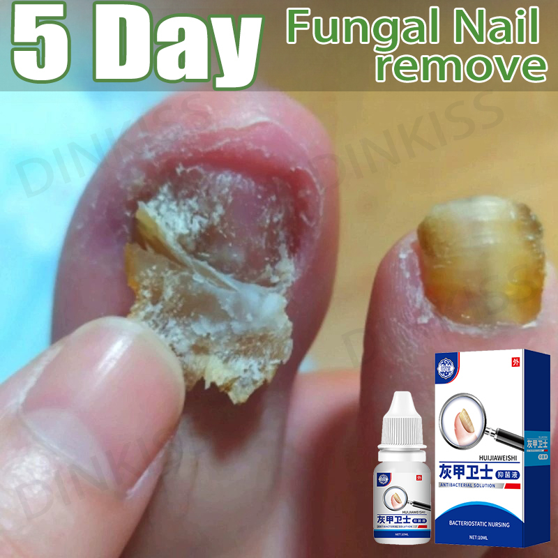 Nail Fungus Treatment Liquid Fungal Nail Treatment Ripair Care Stop ...