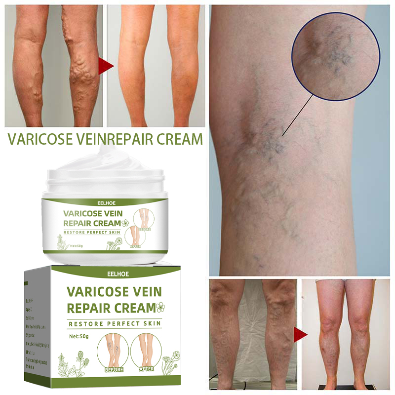 EELHOE Vein Cream Vein Soothing Cream 50g Reduce Spider Vein Pain ...