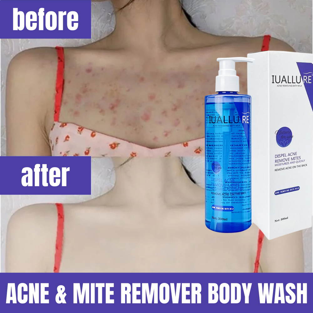 Acne Body Wash Anti Mite Shower Gel Back Mite Removal Remove Acne Deep