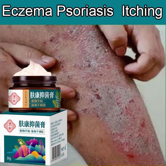 Eczema cream Psoriasis Cream Herbal formula 100 genuine antiitching, antibacterial Repairs