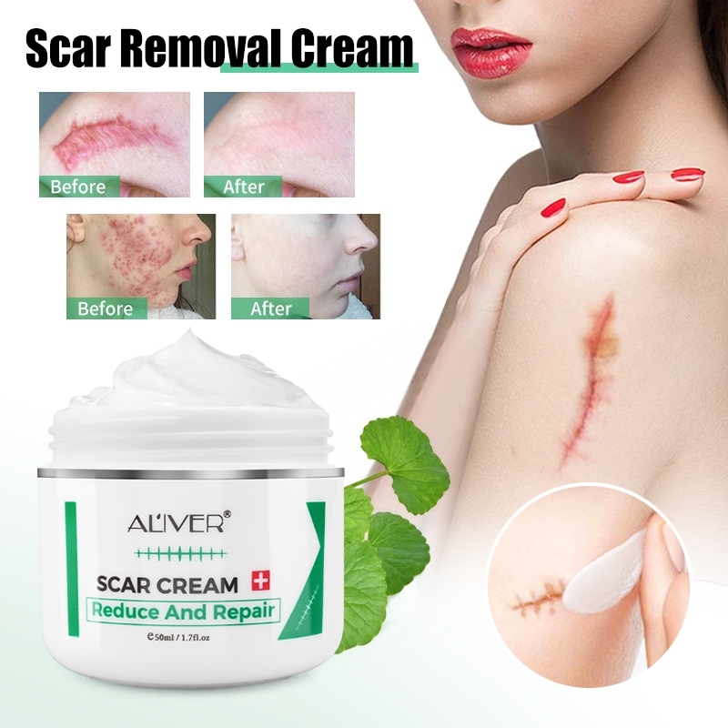 Aliver Natural Herbal Acne Scar Remover Cream Skin Repairing Cream Tcm Scar And Acne Mark 6016