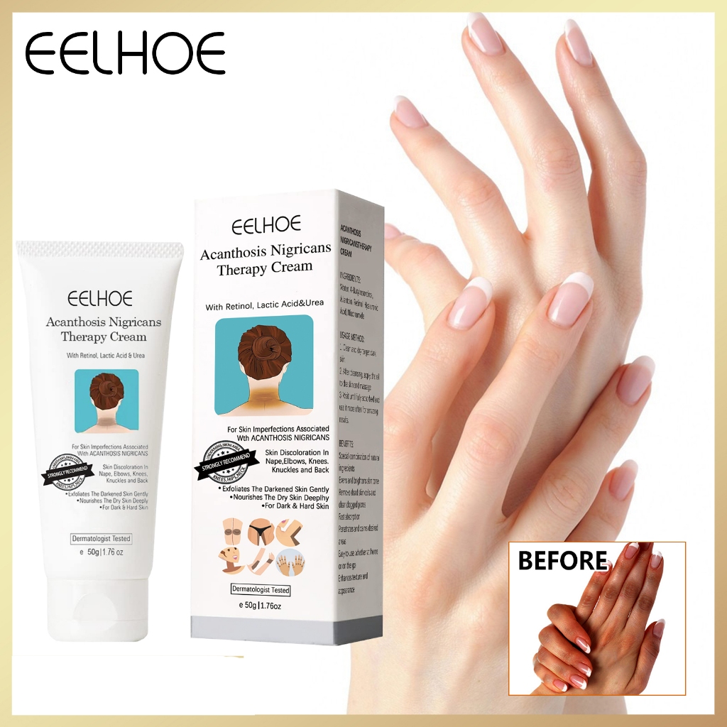 EELHOE Acanthosis Nigricans Therapy Cream 50g Acanthos nigra Repair ...