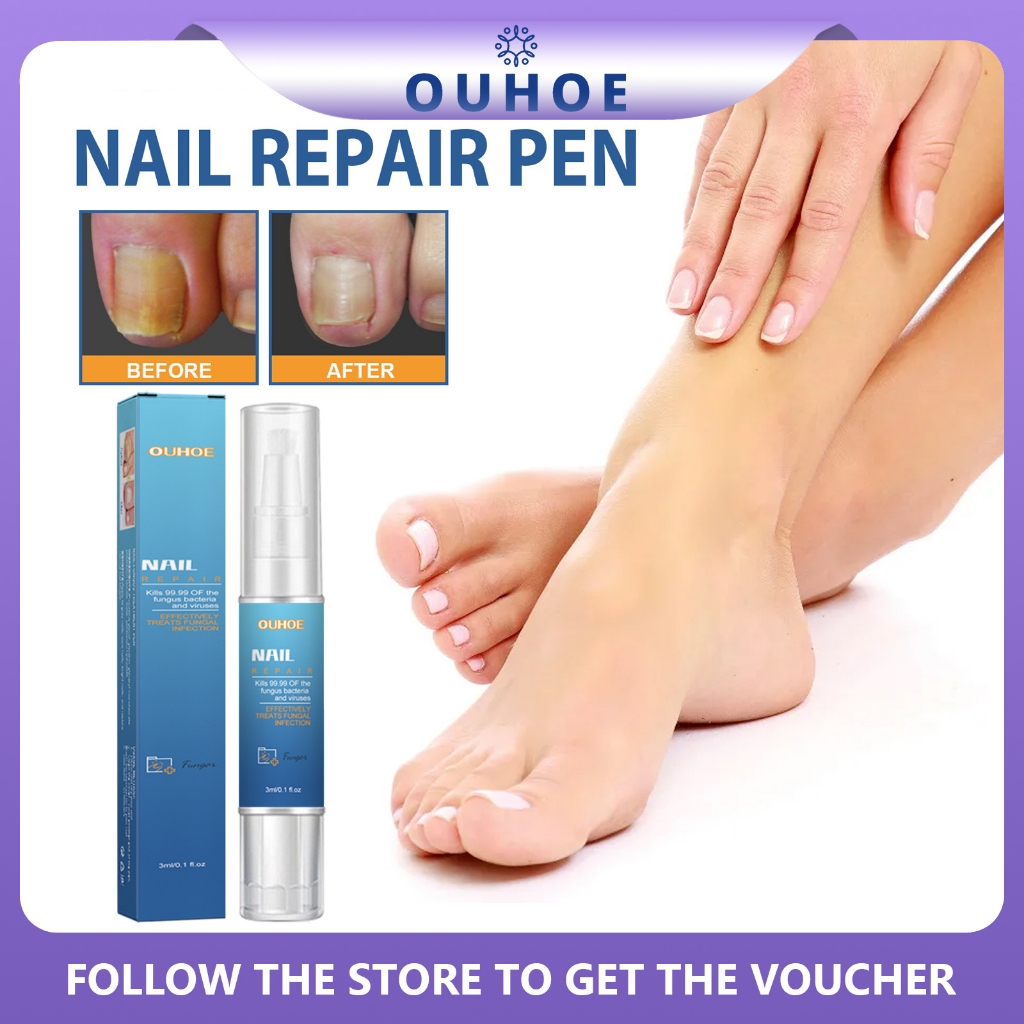 OUHOE Nail Repair Pen3ml Nail Fungal Removal Serum Remove Onychomycosis