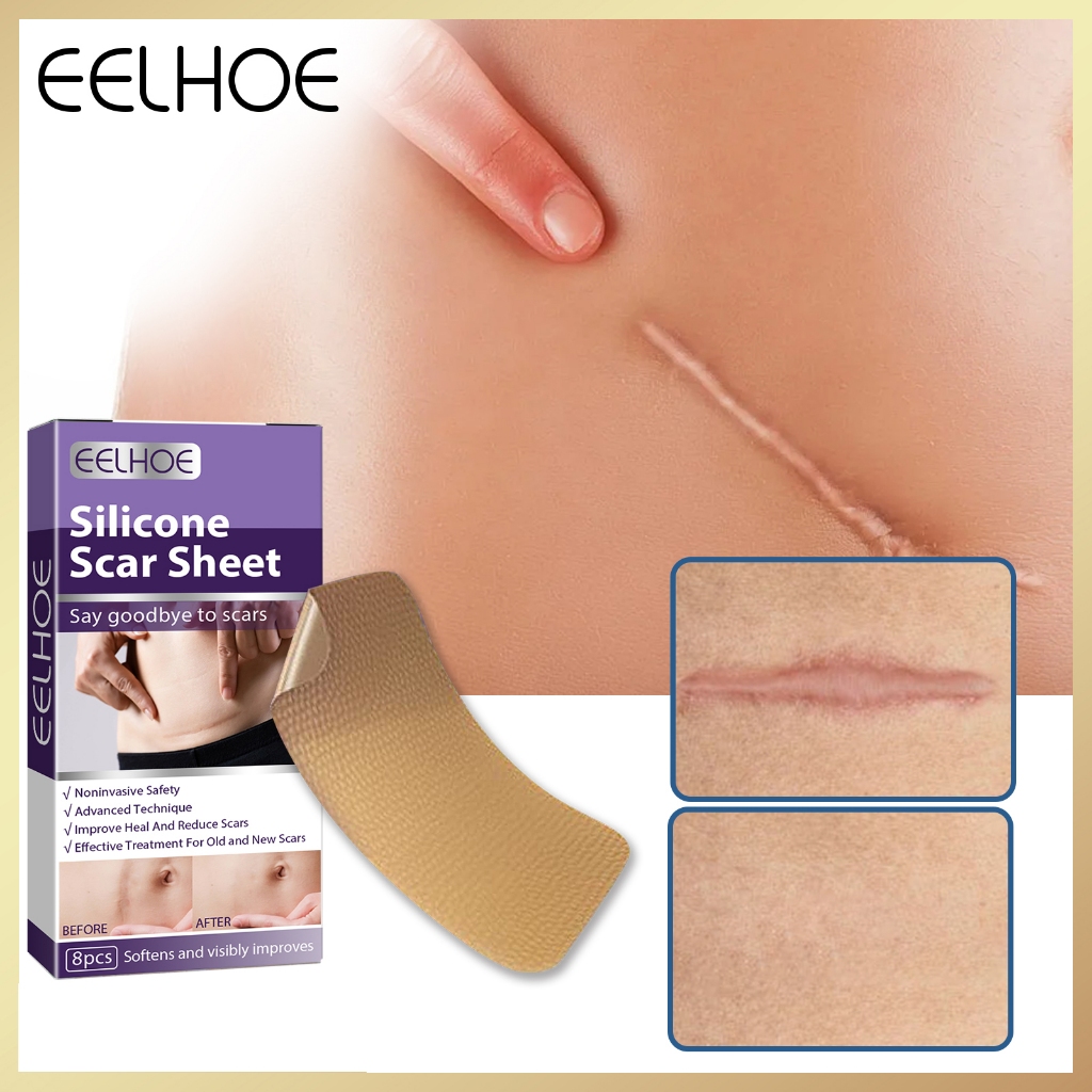 EELHOE Silicone scar sticker Dilute the scar section surgery scar ...