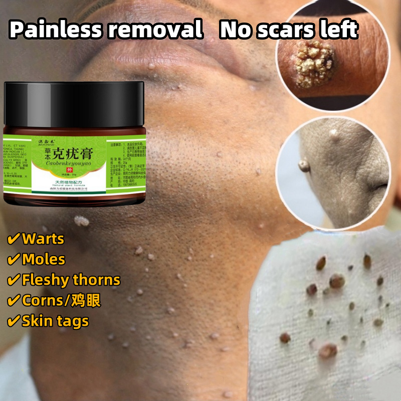 Warts removal cream Mole remover Skin tag removal 20g Safe and Painless