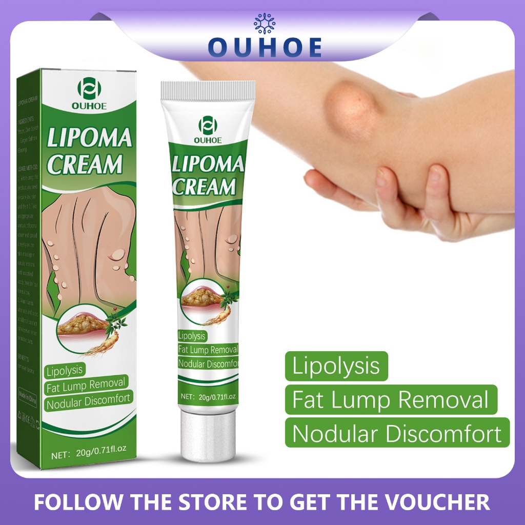 OUHOE Lipoma Removal Cream 20g Treatment Skin Swelling Subcutaneous ...