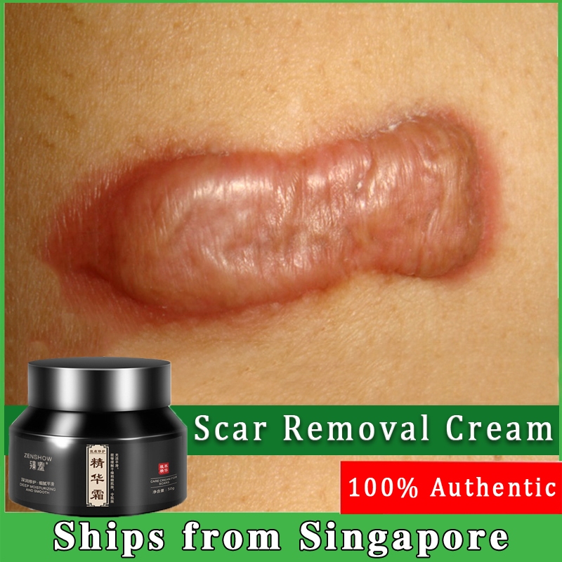 scar removal cream keloid scar removal Repair wound 30g scald cream ...