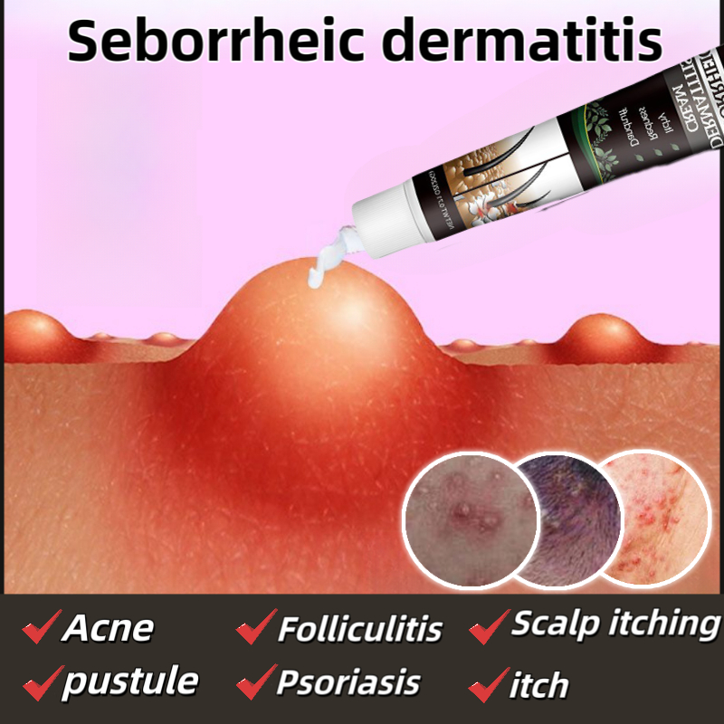 Seborrheic dermatitis cream acne psoriasis cream Scalp folliculitis ...