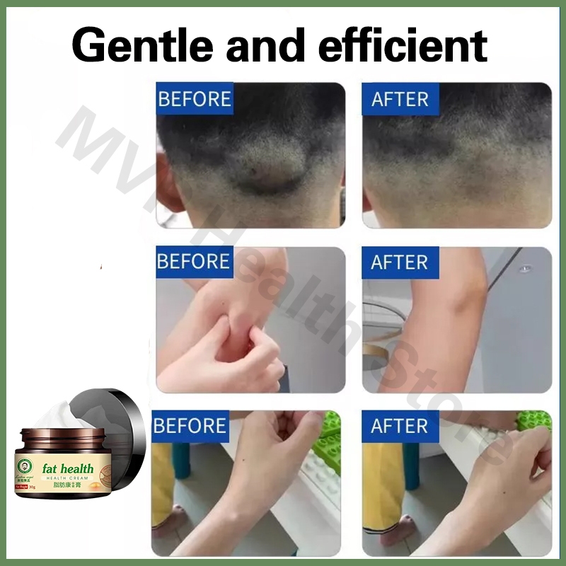 Lipoma Cream 30g Lipoma Removal Cream Multiple Single Lipoma ...