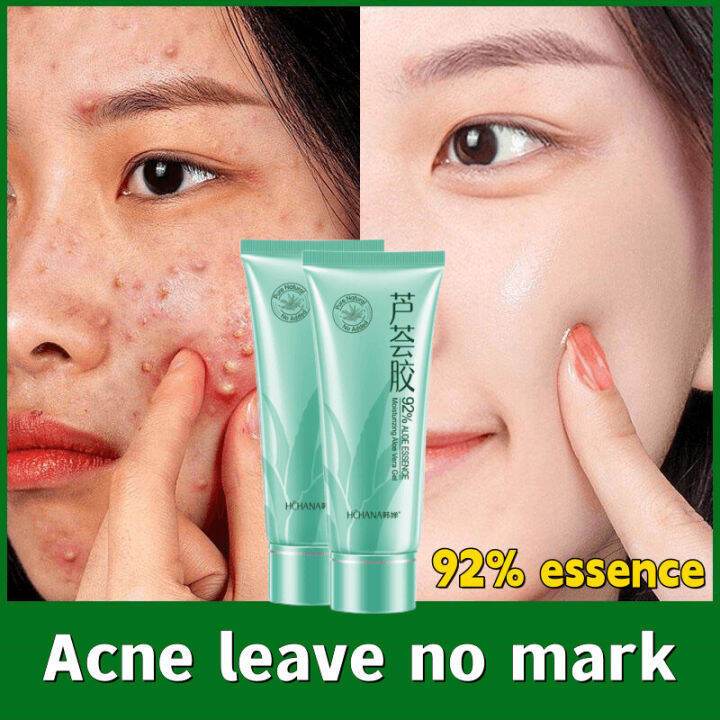 LYDIMOON Aloe vera gel 40g remove acne/acne marks Skin repair after  sunburn/scald Lasting moisture whitening skin | Shopee Singapore