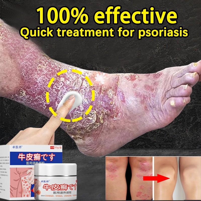Eczema Psoriasis Cream 30g Antibacterial Anti-Itch Dermatitis Ointment ...